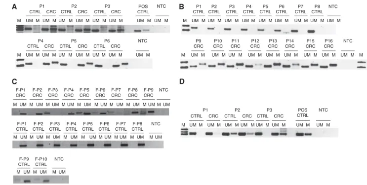 Figure 2 Methylation-specific PCR (MSP) reactions for the miR-34b/c and miR-148a promoter region in tumour and faecal specimens derived from CRC and/or normal individual
