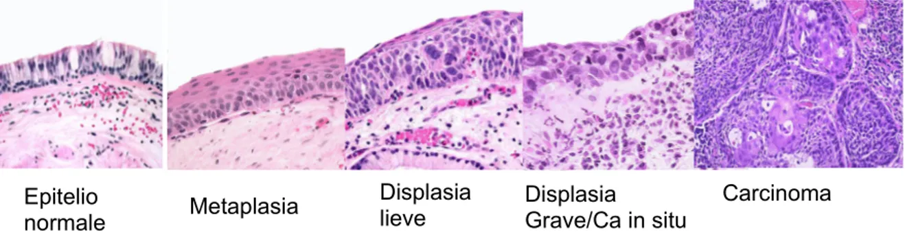 Figura  1  –  Immagini   di   broncoscopia   a   fluorescenza   di   tumori   polmonari.