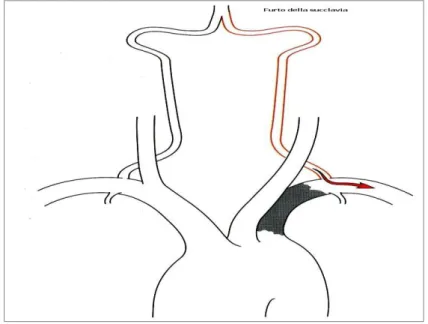 Fig  3.2-  Rappresentazione  schematica  delle  modalità  attraverso  cui  si  realizza  una  sindrome  da  &lt;&lt;furto  della  succlavia&gt;&gt;