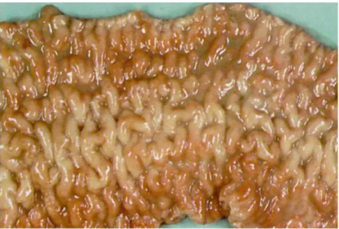 Figura 2.4: Lesioni intestinali