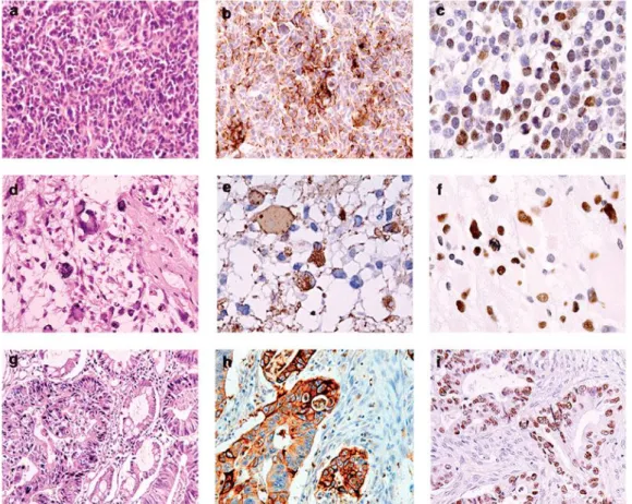 Figure  1.6.  Histological  and  immunohistochemical  evaluation  of  human  tumors  harboring  JCV
