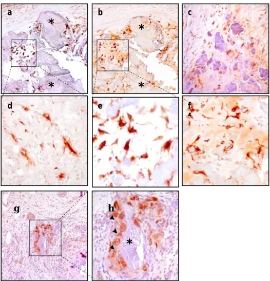 Fig  9.  Immunoistochimica  nella  DAVD.  (*)  Noduli  calcifici.  (a,e  and  b,f)  OPN  in  cellule  con  lunghe  estroflessioni  citoplasmatiche  ed  in  cellule  con  fenotipo  simil  fibroblastico  (100X,  400X)