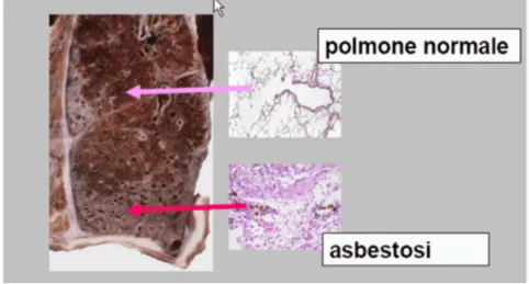 Figura 9 - Polmone patologicamente colpito da asbestosi (Confalone 2002) 