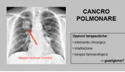 Figura 11 - Carcinoma polmonare (Confalone 2002) 