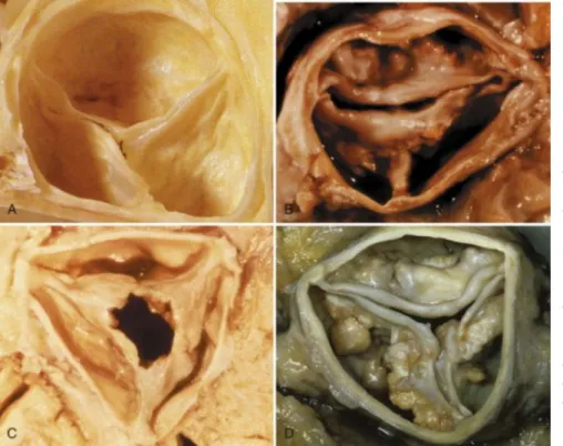 Fig   4.1.  Tipi   principali   di   stenosi   aortica.A.   Valvola   aortica normale