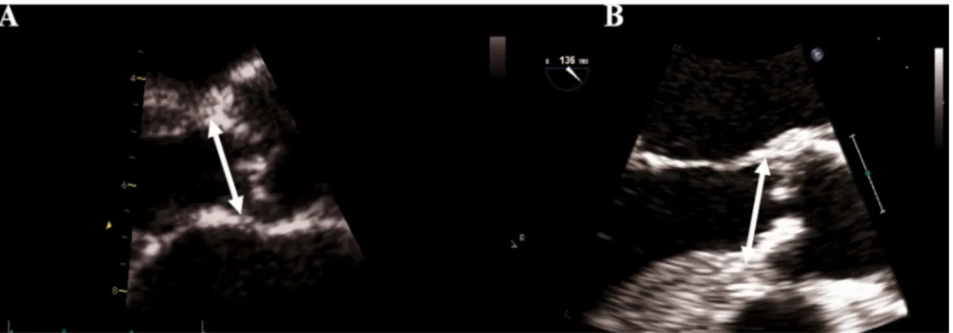 Fig.  4.6.  Misurazione   dell’annulus aortico  mediante   TTE   (A)  e   TEE  (B).   Le  dimensioni   dell’annulus aortico  sono   indicate dalle frecce bianche.
