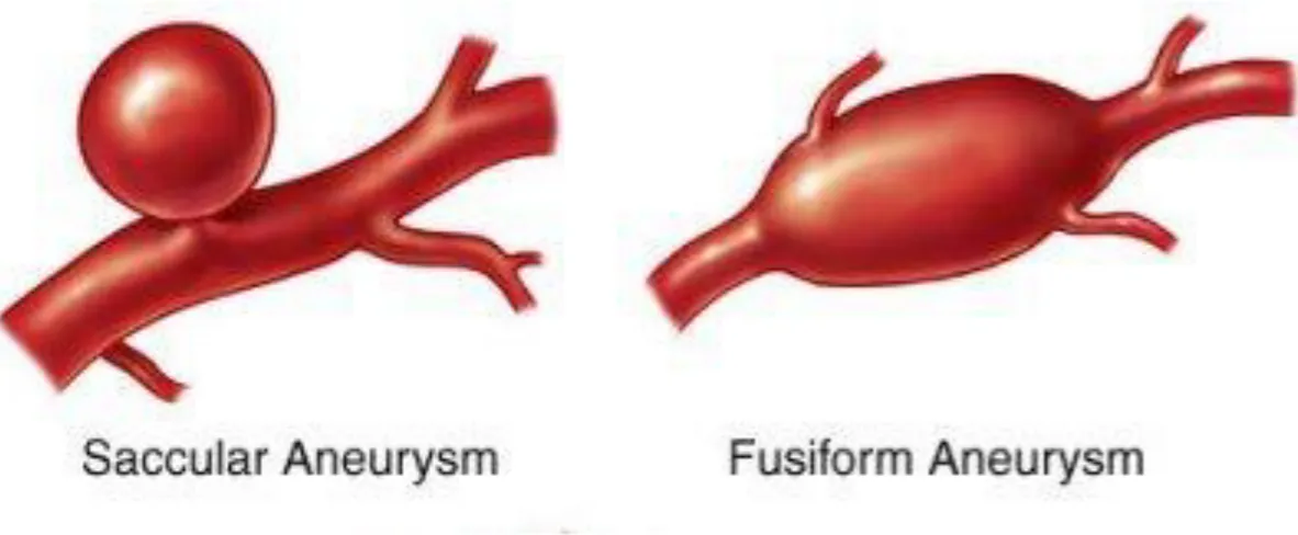 Figura 3: Classificazione degli aneurismi per morfologia. 