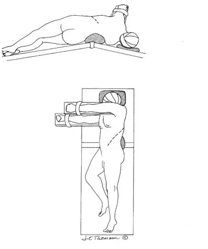 Figura  7:  Posizionamento  del  paziente  sul  tavolo  operatorio  e  lombotomia per chirurgia open con approccio retroperitoneale