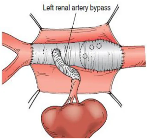 Figura  9:  Anastomosi  della  protesi  ai  vasi  in  aneurisma  iuxtarenale  trattato  con  approccio  retroperitoneale  con  creazione  di  un  bypass  con l’arteria renale sinistra