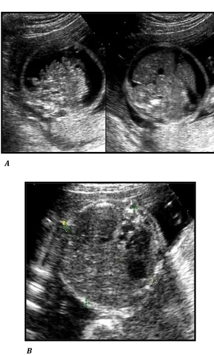 Figura 3. Reperto ecografico di ascite in feto affetto da fibrillazione  atriale a 22 settimane di età gestazionale (A)