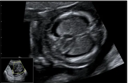 Figura  5a.  Nell’immagine  vediamo  un  quadro  di  idrotorace  monolaterale  (visibile  sia  in  sezione  longitudinale  che  in  trasversale)  associato  ad  agenesia  del  verme  cerebellare  (Variante Dandy-Walker); il neonato non è sopravvissuto