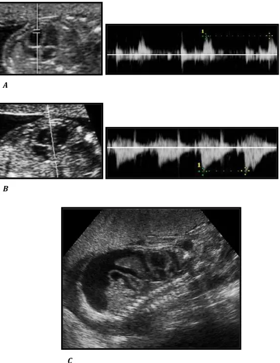 Figura  7.  Blocco  atrio-ventricolare  completo  in  feto  di  madre  con  anticorpi  anti- anti-SSA,  con  frequenza  di  contrazione  ventricolare  =  52  bpm  (A)  e  frequenza  di  contrazione atriale = 103 bpm (B)