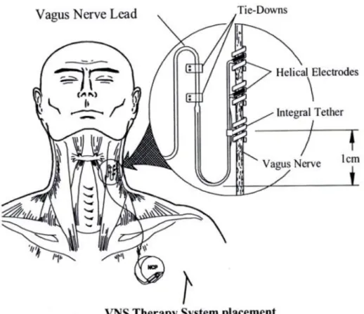 Figura 1.  Sistema dello stimolatore vagale 