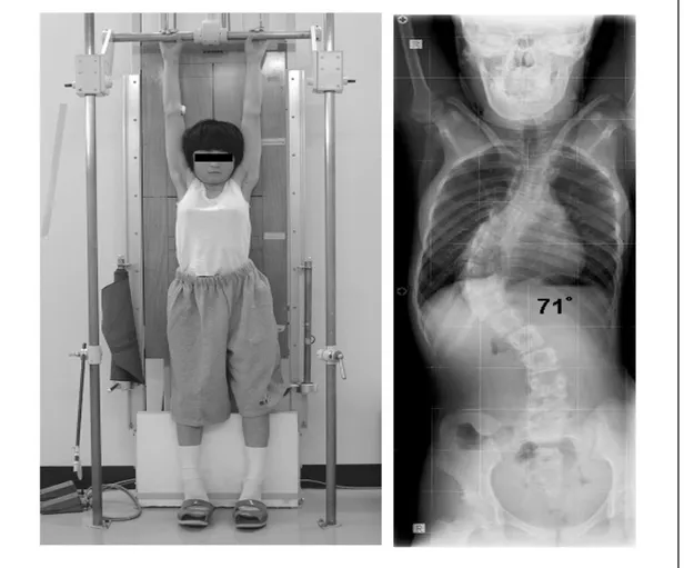 Figura 1.1: esempio di esame radiografico per lo studio della scoliosi in cui è necessaria una radiografia a un’area ampia del corpo [2]
