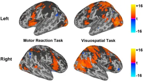 Fig. 4. Left (top) and right (bottom) hemispheres activation contrast maps for the two tasks, where  blue color corresponds to regions strongly activated in naive as compared to professional drivers,  while red color corresponds to regions strongly activat