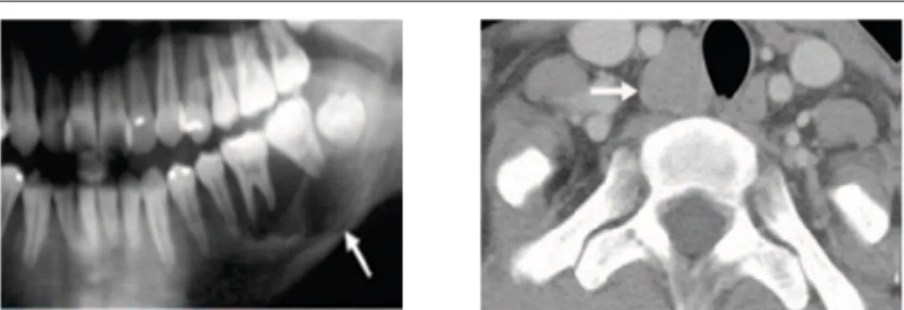 Fig. 7.  A sinistra  radiografia che  dimostra la presenza  di  una massa nel  corpo della  mandibola  (freccia);  a  destra  TAC del  collo che  dimostra  la presenza di una lesione  paratiroidea a destra (freccia)