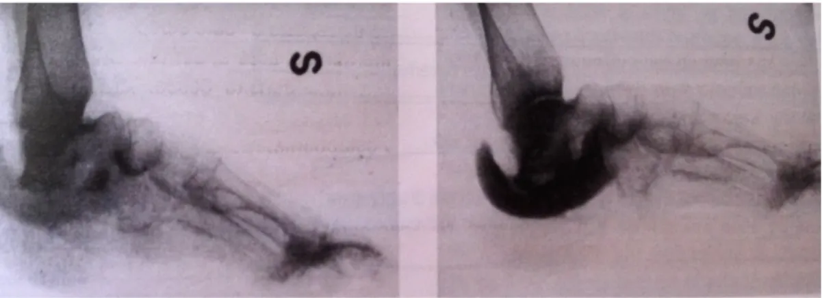 Fig.  9.  Osteopenia  diffusa  e  deformazione  del  calcagno  con  avanzamento  della  superficie articolare calcaneo-astragalica in un  paziente con  adenoma paratiroideo (a  sinistra)