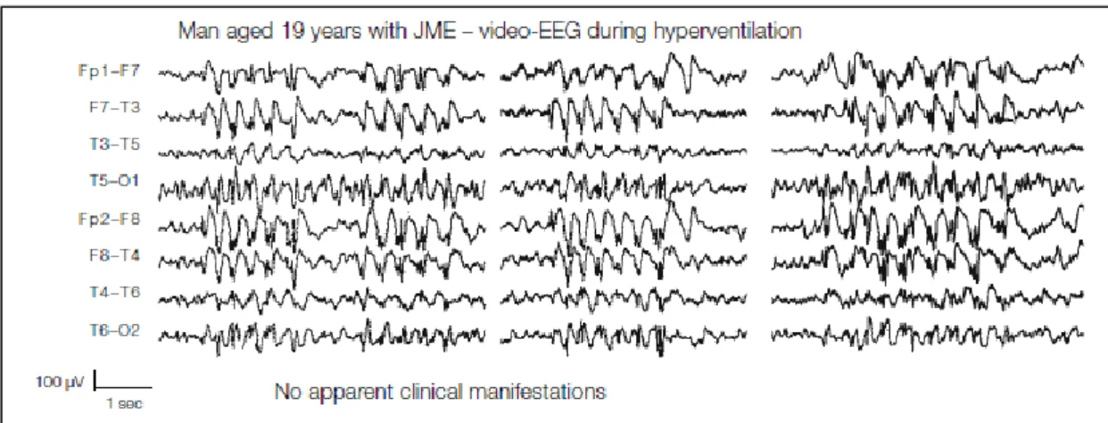 Figura 4. Anomalie intercritiche nell’epilessia mioclonica giovanile.  