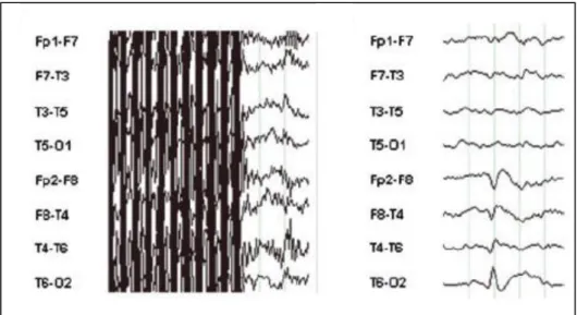 Figura 12. Esempio di artefatto da gradiente durante acquisizione EEG-fMRI.