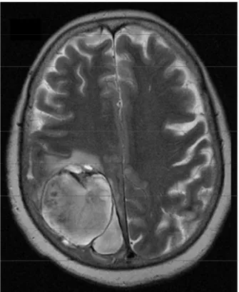 Figura 2: RM di paziente con PACNS. L’immagine T2-pesata rivela una recidiva di emorragia  cerebrale in corrispondenza di una lesione malacica (da Pizzanelli et al, 2011 71 )