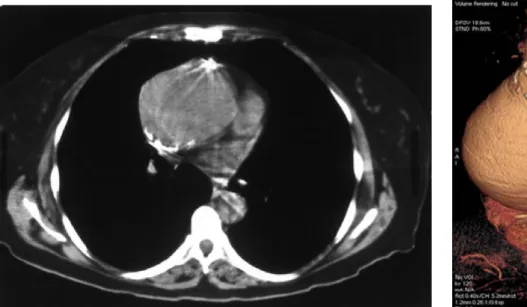 Fig. 12 : Immagine TC di una sezione trasversale del torace  che   evidenzia   un'aneurisma   dell'aorta   ascendente   di   8  cm