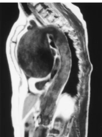 Fig.   14:   Immagine   coronale   dello   stesso  paziente   dell'immagine   precedente