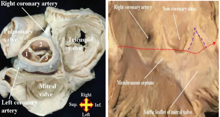 Fig. 2: Il cuore è stato privato del tetto degli  atri e viene visualizzato dall'alto, con la stessa  prospettiva del chirurgo in sala operatoria