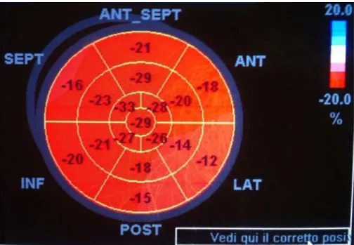 Figura 5 Esempio di bull's eye. Al centro sono rappresentati i segmenti apicali, in periferia  quelli basali