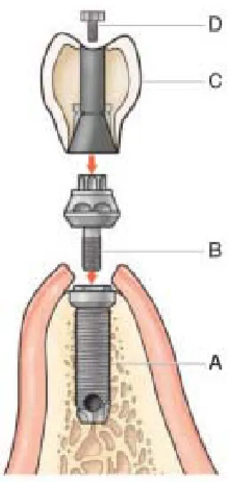 Fig. 1.3  I componenti di un sistema implantare sono il corpo implantare o fixture (A) e il pilastro protesico o a- a-butment (B)