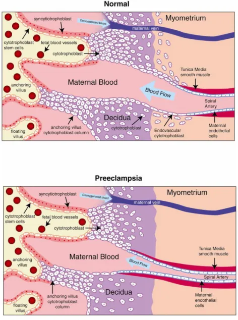 Fig     3: Invasione citotrofoblastica delle arterie spirali nella gravidanza fisiologica e  nella preeclampsia.