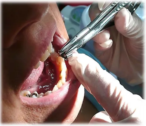 Figura 3: Dettaglio del  prelievo di placca sopra-gengivale  Nella foto è possibile notare la placca che rimane adesa al bordo  della  matrice  durante  lo  sfregamento  della  superficie  vestibolare  del dente
