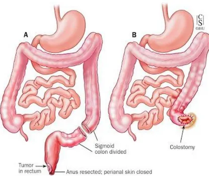 Figura  7.  Resezione  addomino-perineale  secondo  Miles:  come  mostrato,  dopo  l’asportazione  del  sigma, del retto e dell’ano (A) è necessaria la creazione di una stomia definitiva (B)