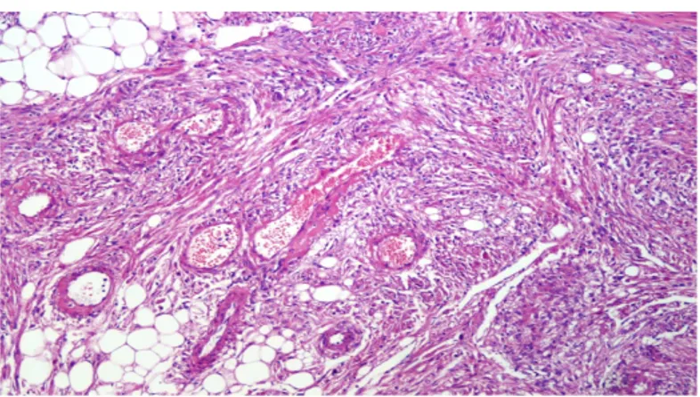 Fig. 2: Immagine microscopica di Angiomiolipoma renale