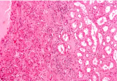 Fig. 3: Immagine microscopica di Oncocitoma renale.