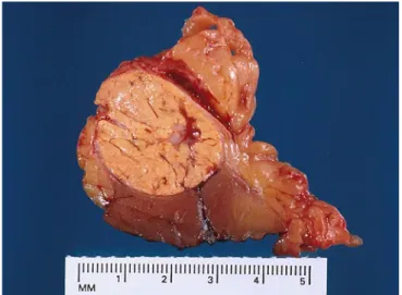 Fig. 4: Aspetto macroscopico di un carcinoma a cellule renali