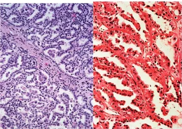 Fig. 6: Immagine microscopica di carcinoma renale papillare tipo I e II