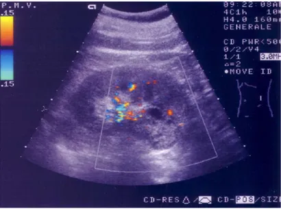 Fig. 7: Ecografia rene sinistro: carcinoma renale in sede corticale antero-inferiore 