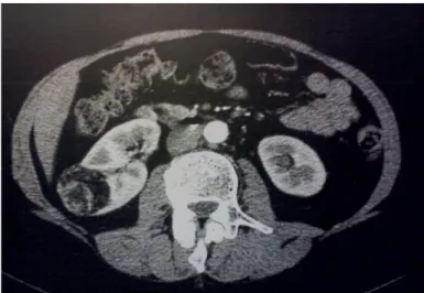 Fig. 8: Immagine Tc di un Angiomiolipoma renale destro 