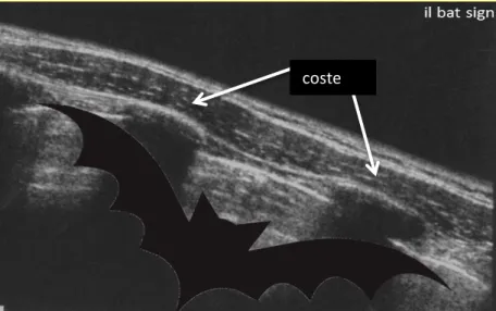 Fig 3. Immagine ecografica in scansione trasversale intercostale in cui si individua l’aspetto  caratteristico del bat sign