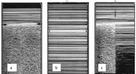 Fig 10: Immagini ottenute con metodica M-mode in cui si visualizza a) sea shore fisiologico in  un soggetto sano con sliding pleurico; b) stratophere sign che indica la completa assenza della  dinamica pleurica e dello slinding in un soggetto con pneumotor