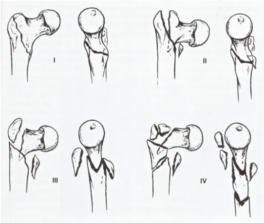 Fig. 8: classificazione di Kyle e Gustilo.