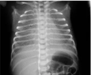 Fig.  3:  Radiografia  del  torace  di  un  neonato  con  RDS:  Polmoni  scarsamente  areati  con  il  modello  reticolo-nodulare “a vetro smerigliato”