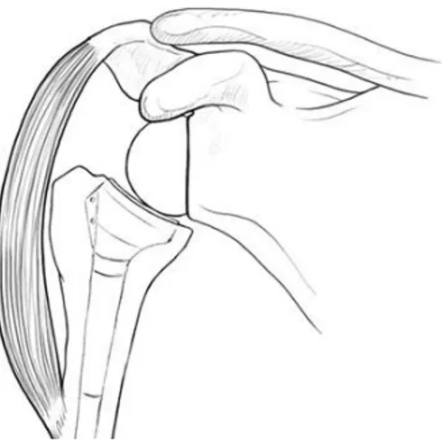 Figura 5. La protesi inversa di spalla. 