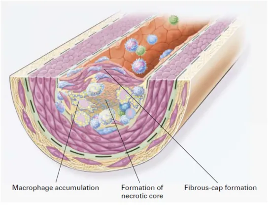 Figura 1.5: Formazione della lesione avanzata in seguito alla migrazione delle cellule muscolari lisce