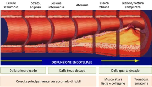 Figura 1.10: Classicazione delle lesioni aterosclerotiche