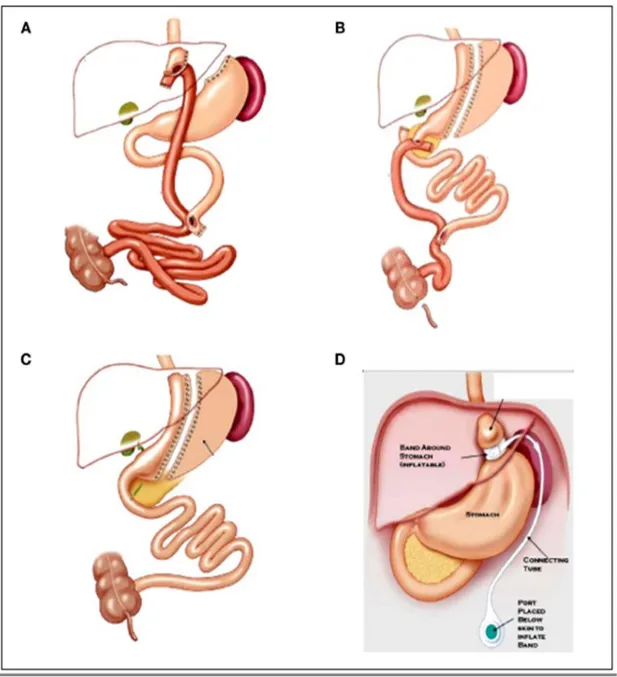 Figura  1:  le  principali  procedure  di  chirurgia  bariatrica.  A:  bypass  gastrico  su  ansa  alla  Roux;  B:  diversione  bilio-pancreatica;  C: 