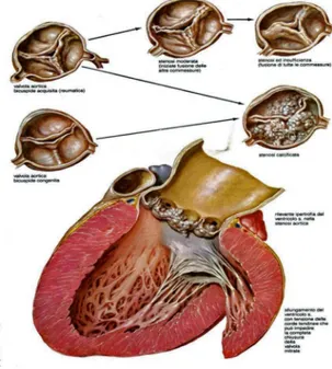 Figura -1- Rappresentazione della Morfologia e degli effetti fisiopatologici della stenosi aortica