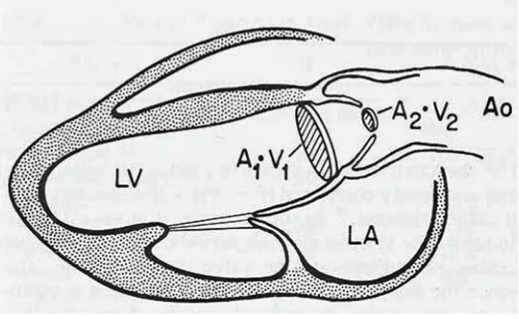 Figura  -5-  Calcolo  dell’area  aortica  usando  l’equazione  di  continuità:  il  flusso  di  sangue  che  fuoriesce  dal  ventricolo  sinistro  è  calcolato  moltiplicando  A1  per  V1,  questo  prodotto  è  diviso  per  la  velocità transvalvolare V2, 