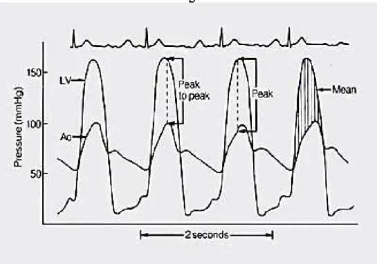 Figura -6- Tracciato emodinamico di un paziente con stenosi aortica: sono osservabili due tracce  pressorie simultanee, una del ventricolo sinistro (LV) e l’altra dell’aorta (Ao)