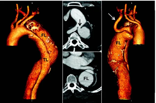 Figura 3.1: Esempio di vero lume (TL) e falso lume (FL) in seguito ad un processo di dissezione della parete aortica.